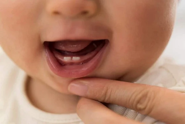 Neonatal and Natal Teeth Treatment