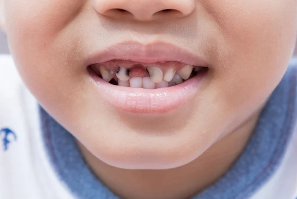 Cavity Treatment