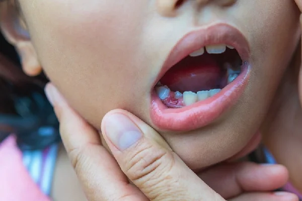 Root Canal Treatment of Permanent Teeth